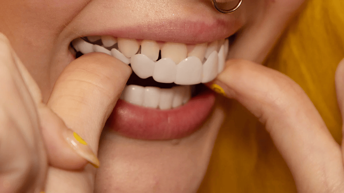 Carillas Dentales Instantáneas Reutilizables